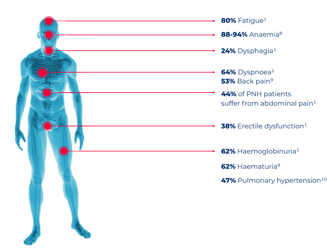 Image showing typical signs and symptons of PNH